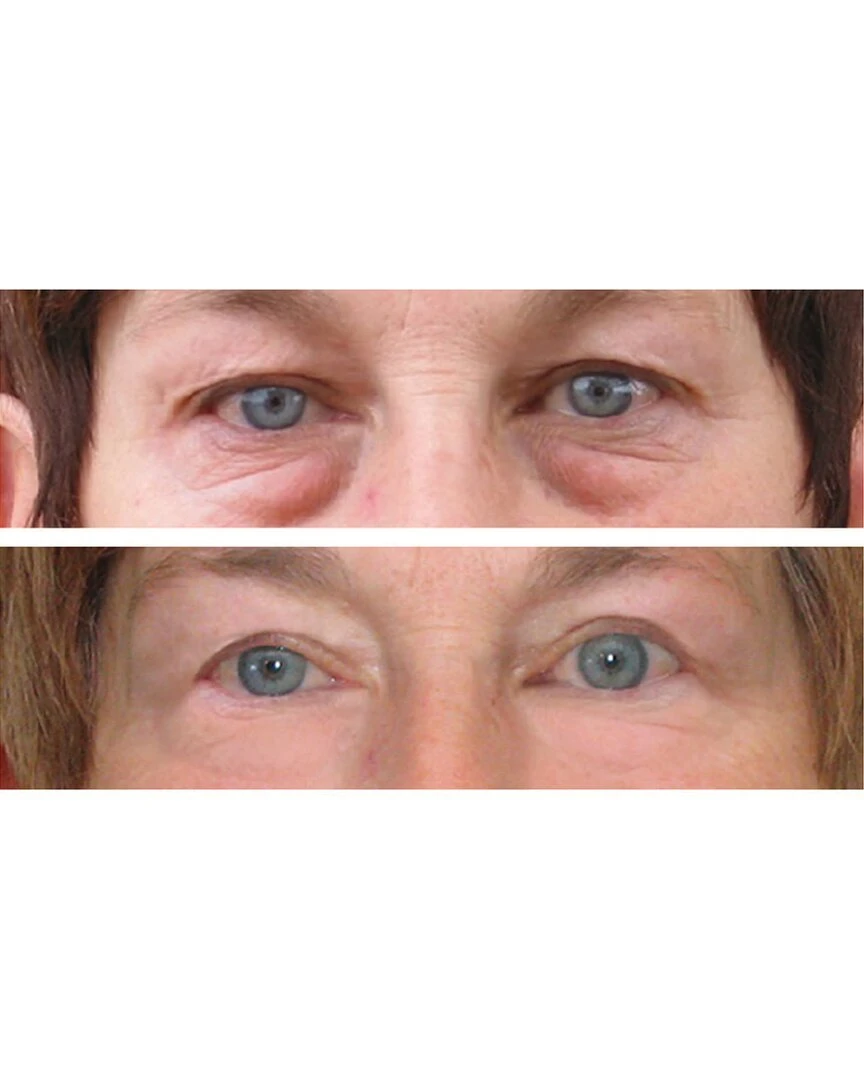 Predire Paris 50X Vitamin A Retinol Anti-Wrinkle & Intensive Rapid Renewal Eye Serum Set Women Skincare Treatments Predire Paris 50X Vitamin A Retinol Anti-Wrinkle & Intensive Rapid Renewal Eye Serum Set Women Skincare Treatments -PREDIRE PARIS Sales 1111496731 RLLZ 2